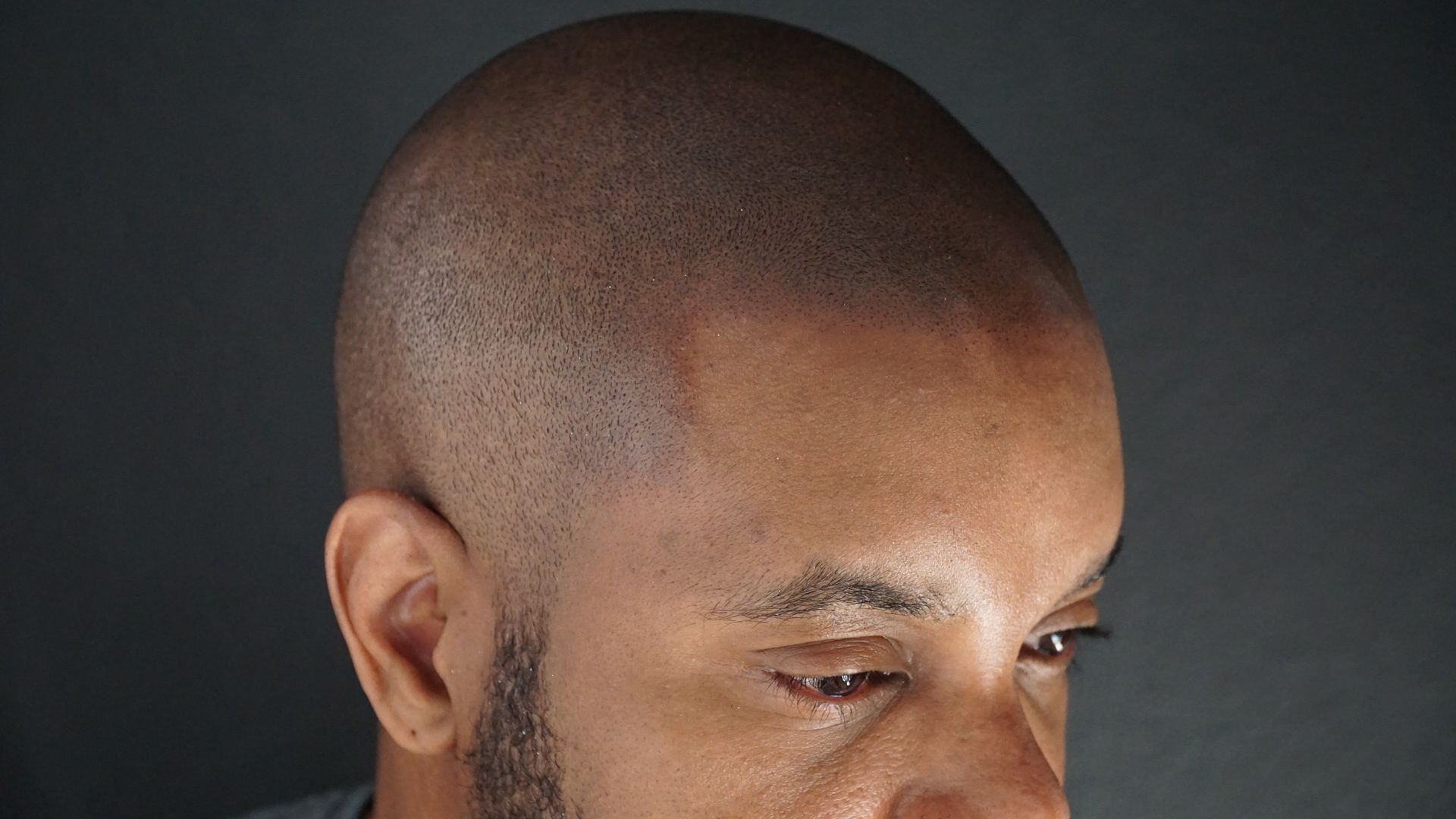 What is Scalp Micro-pigmentation?